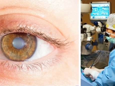 Lékaři varují před přezrálým šedým zákalem, operace je náročnější